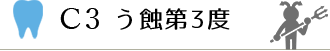 C3 う蝕第3度